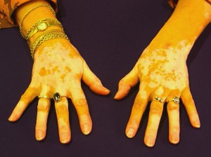 A vitiligo kezelésére vannak módszerek